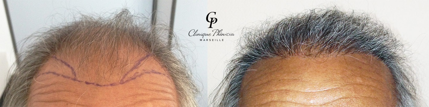 greffe cheveux marseille greffe cheveux marseille
