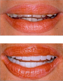 facette3