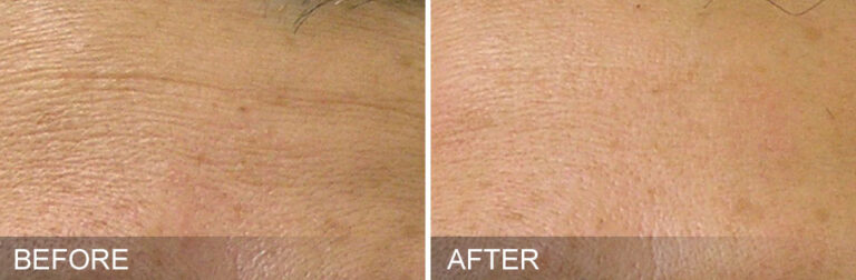 Hydrafacial  Avant Après  Clinique esthétique Phenicia Marseille