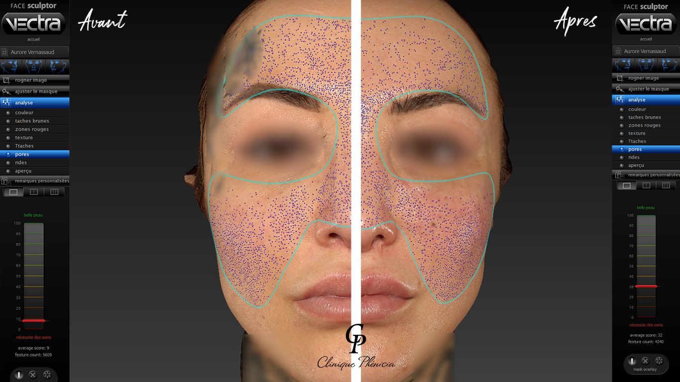 Analyse de peau à partir du logiciel 3D VECTRA avant et après le soin Hydrafacial signature