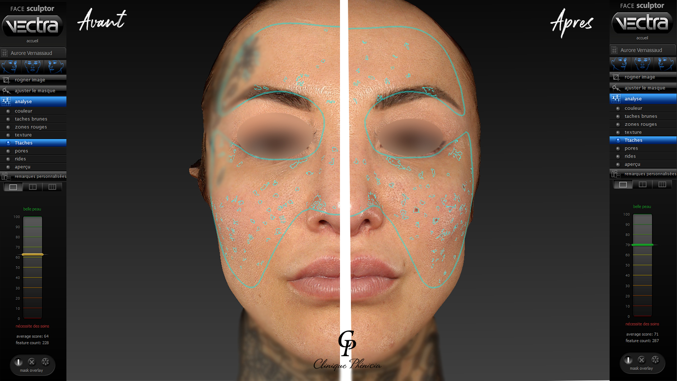 Résultat du patient lors du BILAN de peau 3D sur les tâches amélioré 