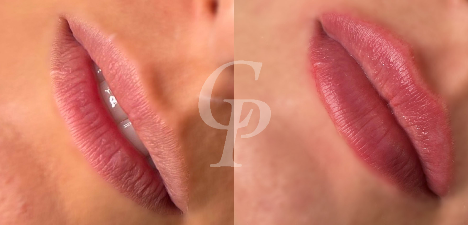 dermopigmentation lèvres avant/après