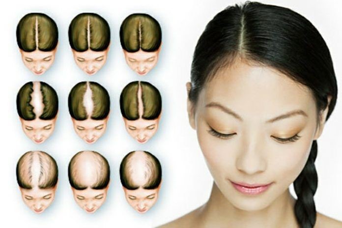 Ce qu'il faut savoir sur la perte de cheveux