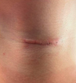 Avant traitement LPG sur cicatrice