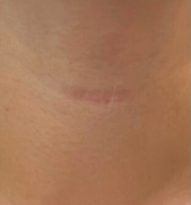 Après traitement LPG sur cicatrice