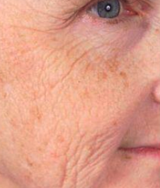 Avant traitement laser CO₂ fractionné – texture et cicatrices