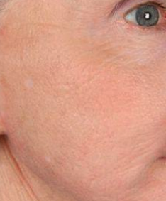 Après traitement laser CO₂ fractionné – peau plus lisse et uniforme