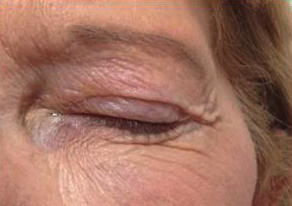 Avant blépharoplastie médicale au laser CO2 - Clinique PHENICIA