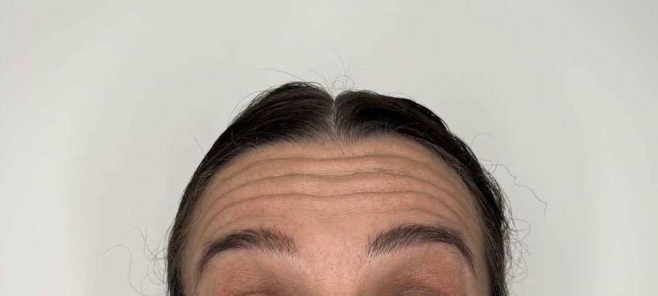 Avant traitement Botox