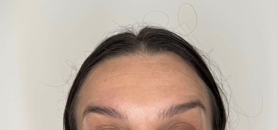 Après traitement Botox