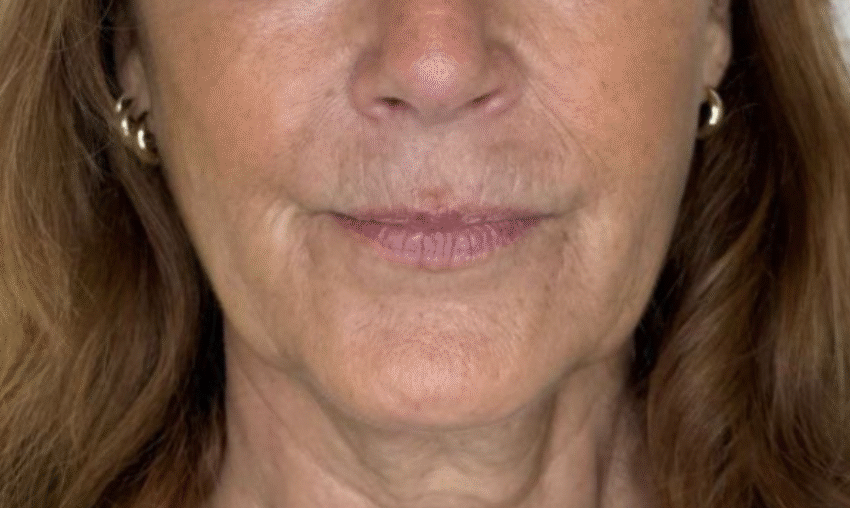 Avant traitement Botox front