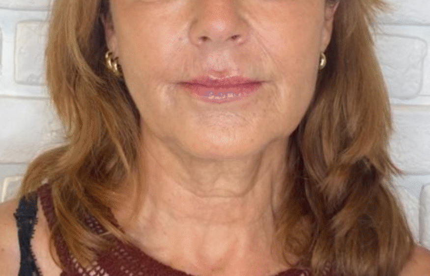 Après traitement Botox front