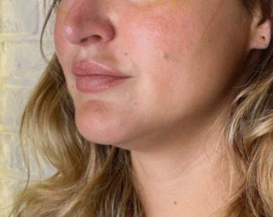 Avant Botox pattes d’oie