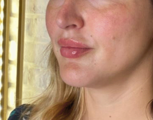 Après Botox pattes d’oie