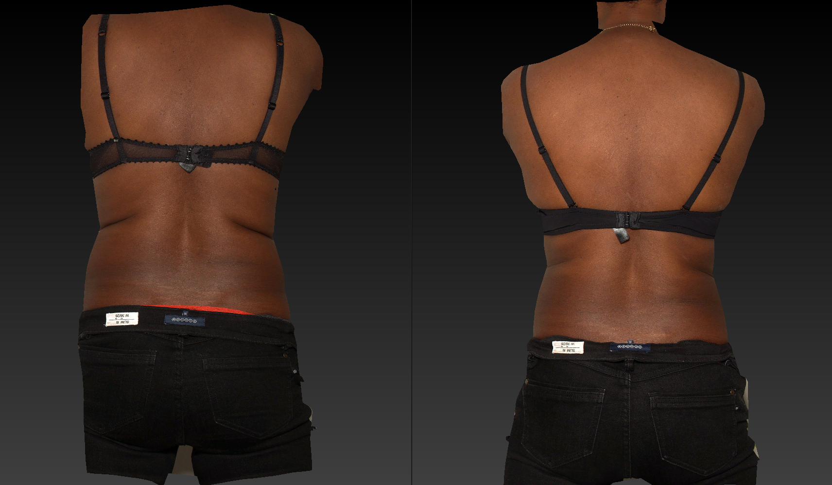 Résultat après cryolipolyse du pli du soutien-gorge