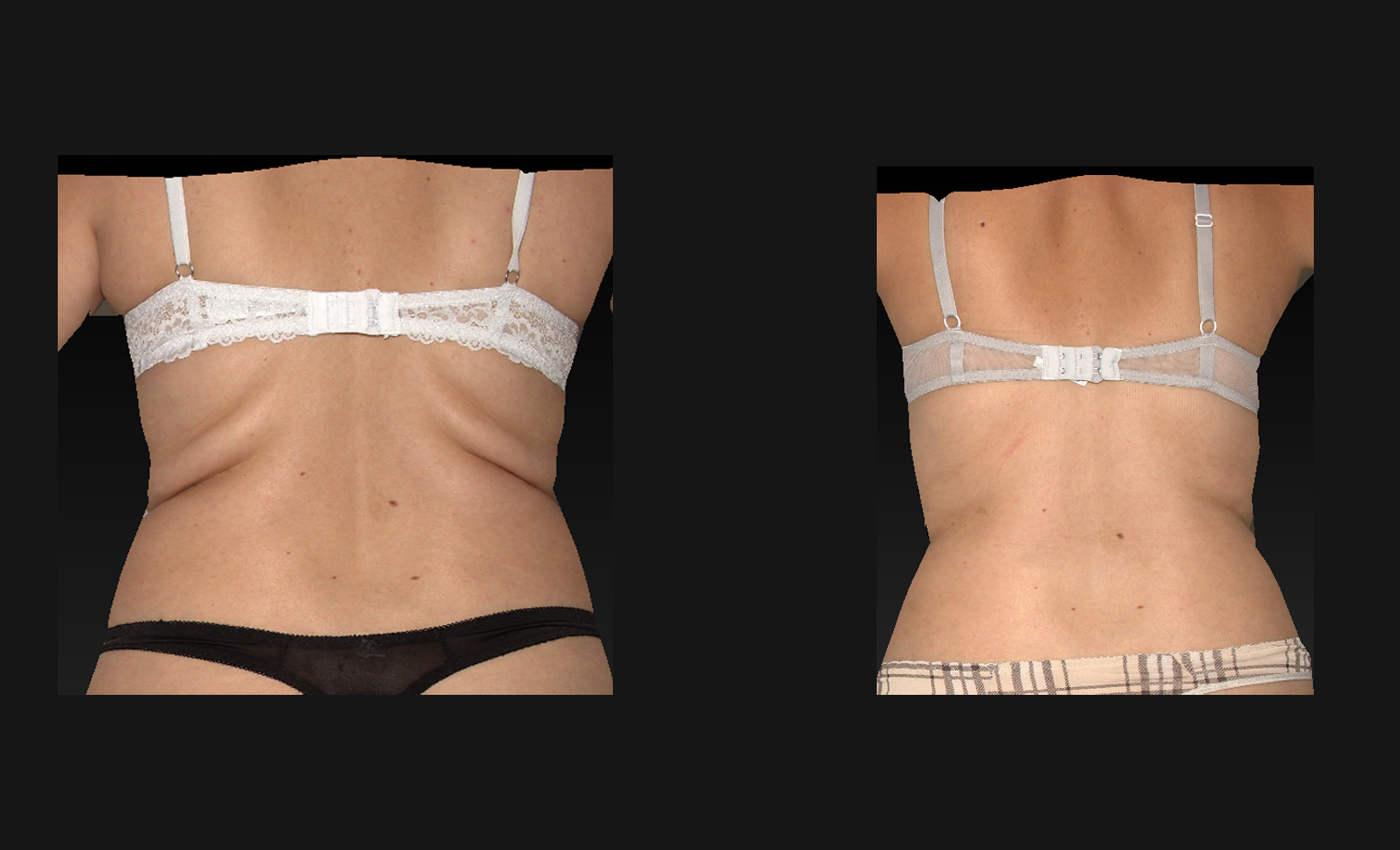 Avant après cryolipolyse du pli du soutien-gorge