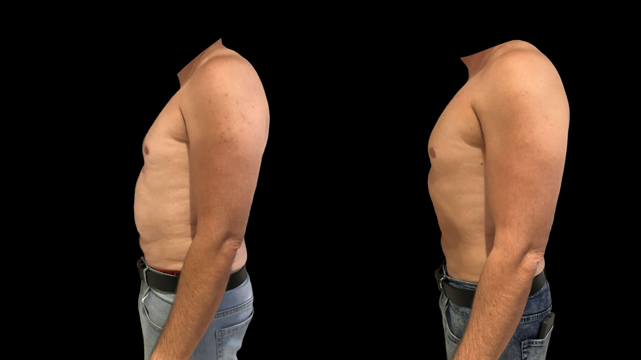 Avant après cryolipolyse du ventre