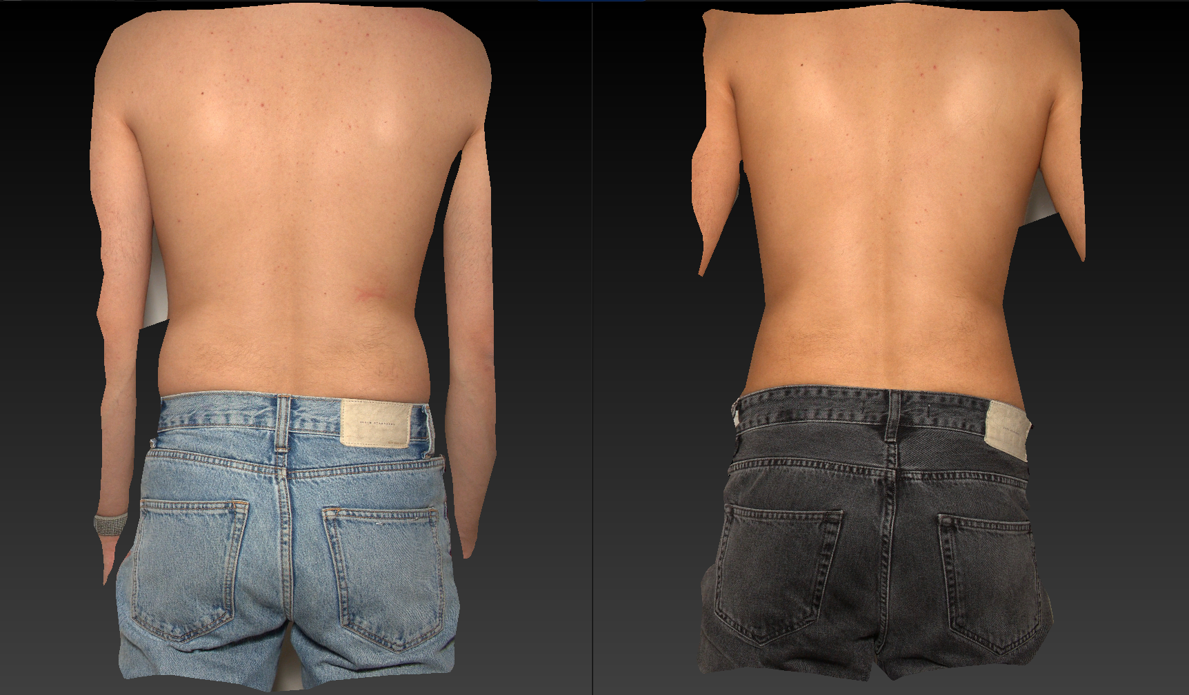 Après 2 séances de cryolipolyse des flancs