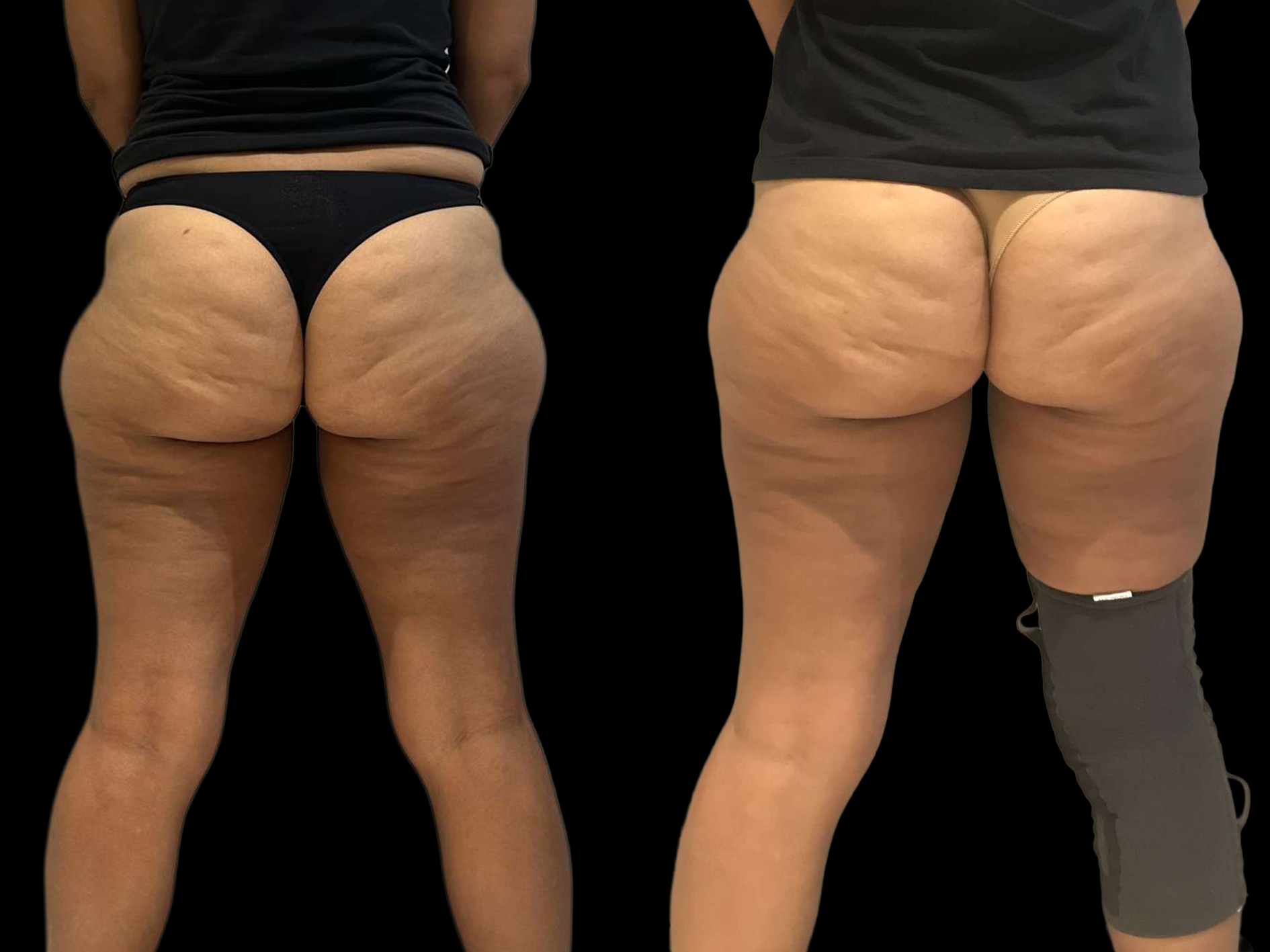 Résultat après cryolipolyse de la culotte de cheval