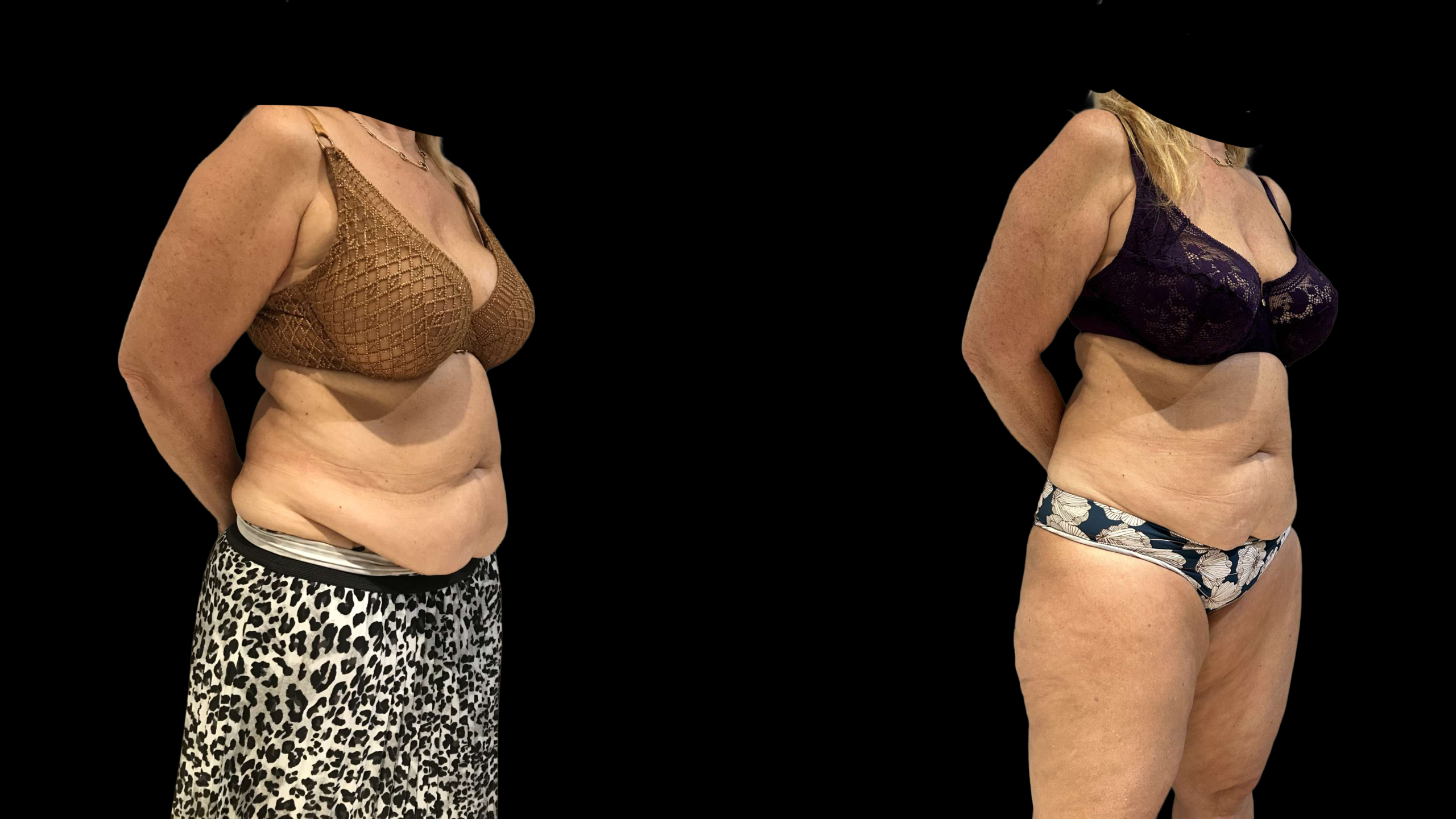 Résultat après cryolipolyse du ventre