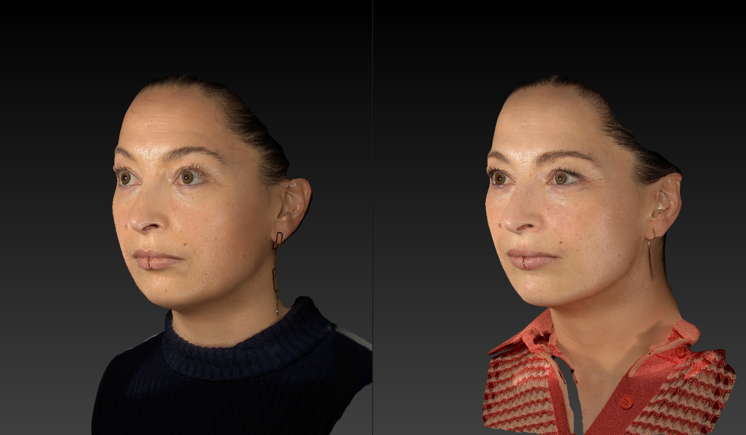 Avant après cryolipolyse du double menton