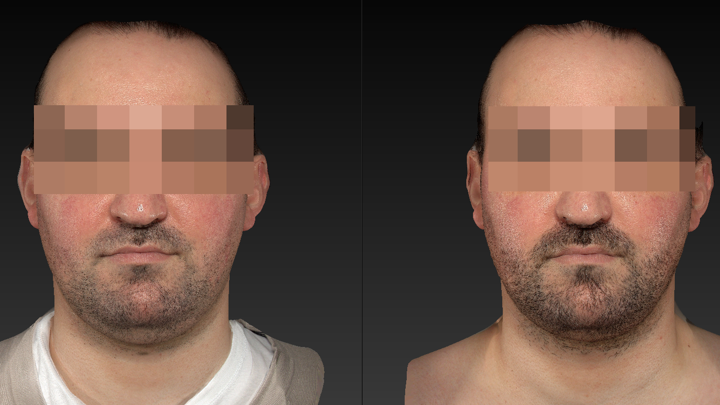 Résultat après cryolipolyse du double menton