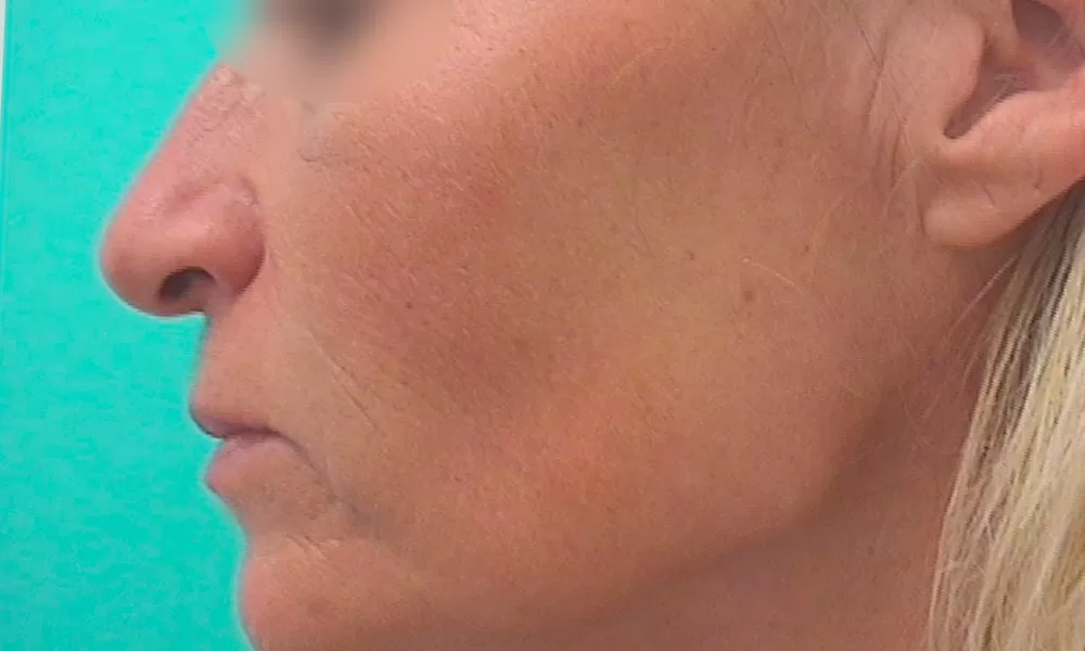 Après plusieurs séances de luminothérapie LED visage