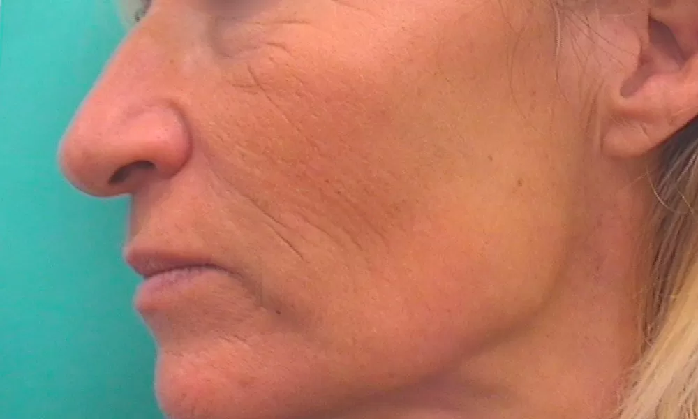 Avant luminothérapie LED visage