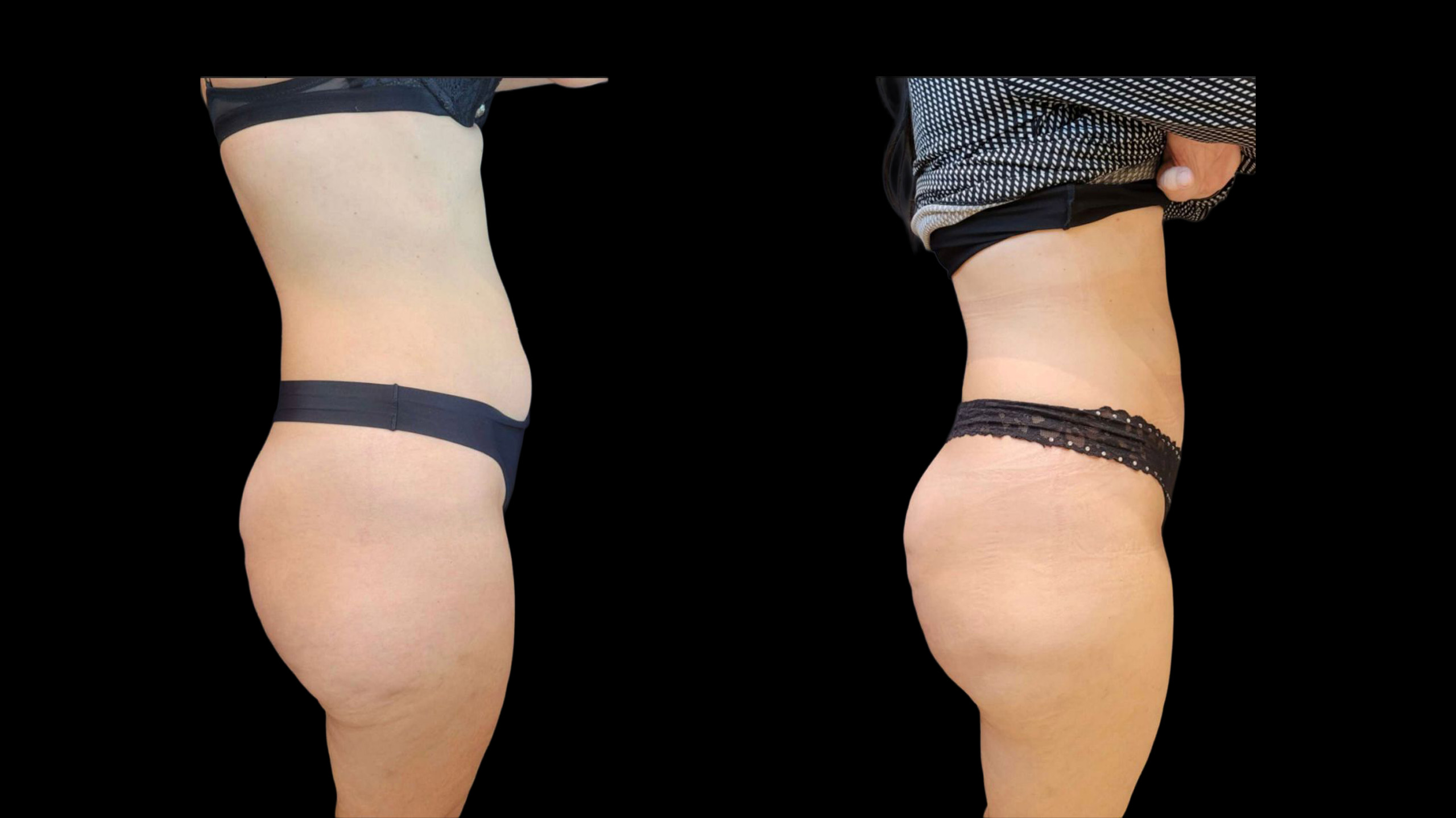 Avant après cryolipolyse médicale Crystal Pro ventre Clinique Phénicia Marseille