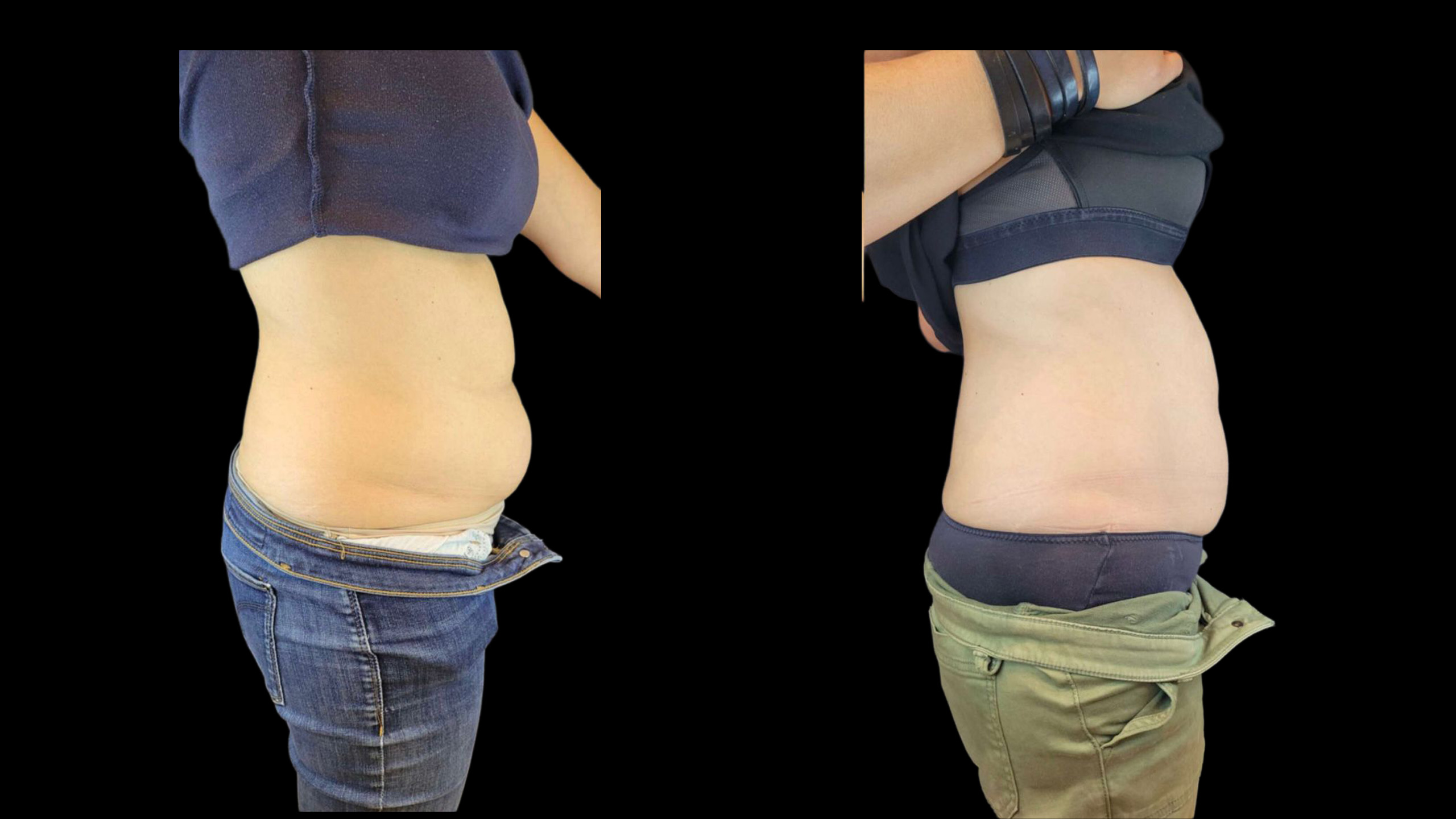 Résultat après cryolipolyse médicale Crystal Pro du ventre