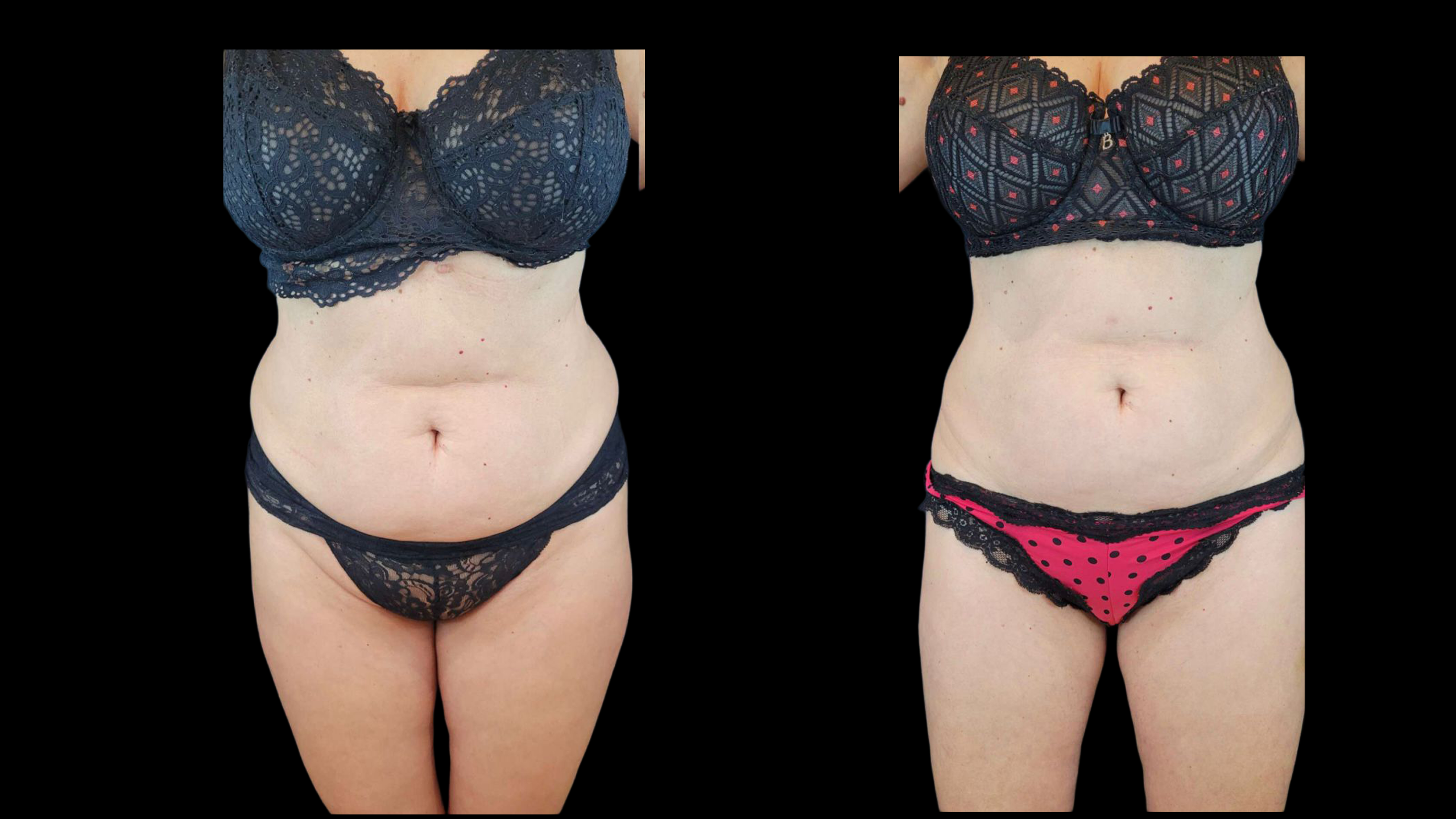 Avant après cryolipolyse médicale du ventre à la Clinique Phénicia Marseille