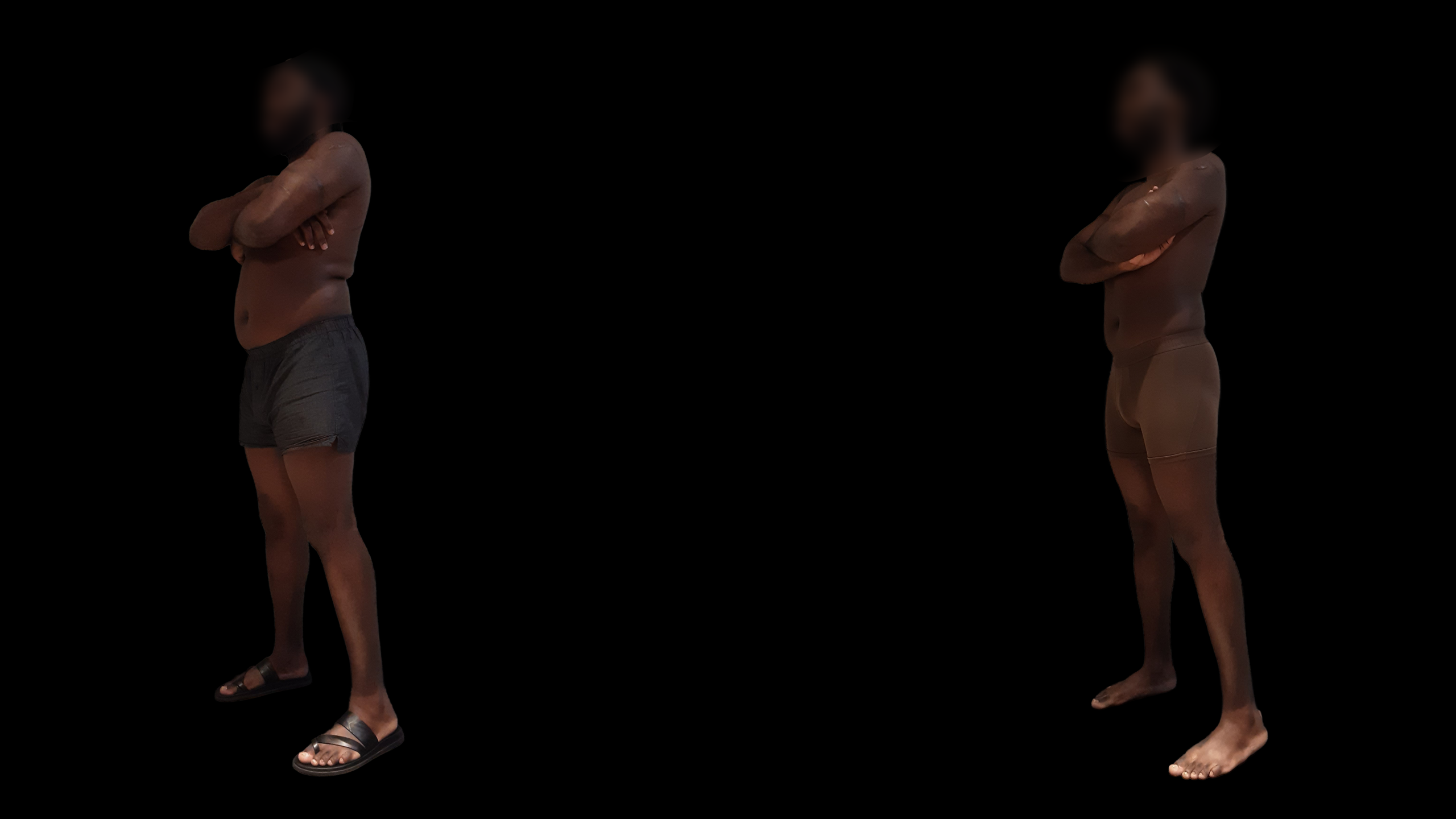 Avant après perte de poids GLP-1 1