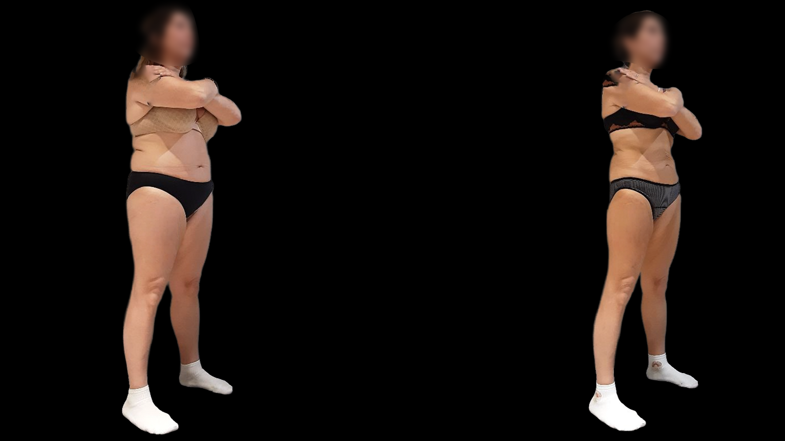 Avant après perte de poids GLP-1 2