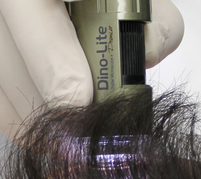 Analyse capillaire par trichoscopie médicale à la Clinique Phénicia Marseille