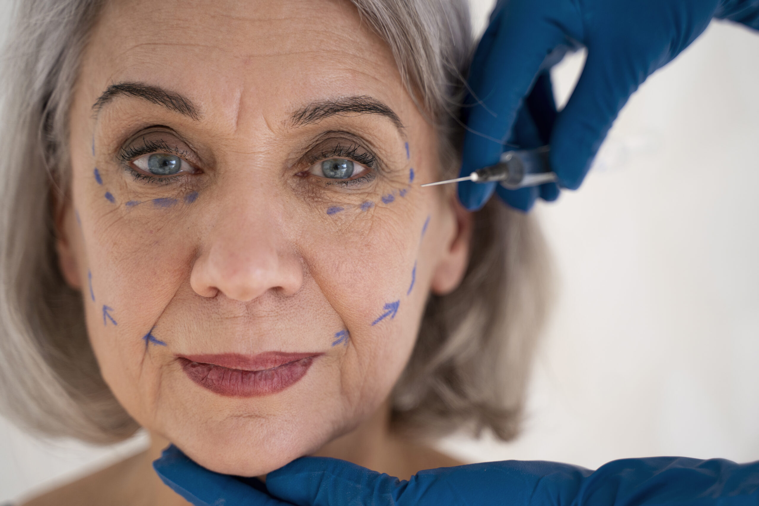 Marquage du visage avant la pose de fils tenseurs pour un soft lifting