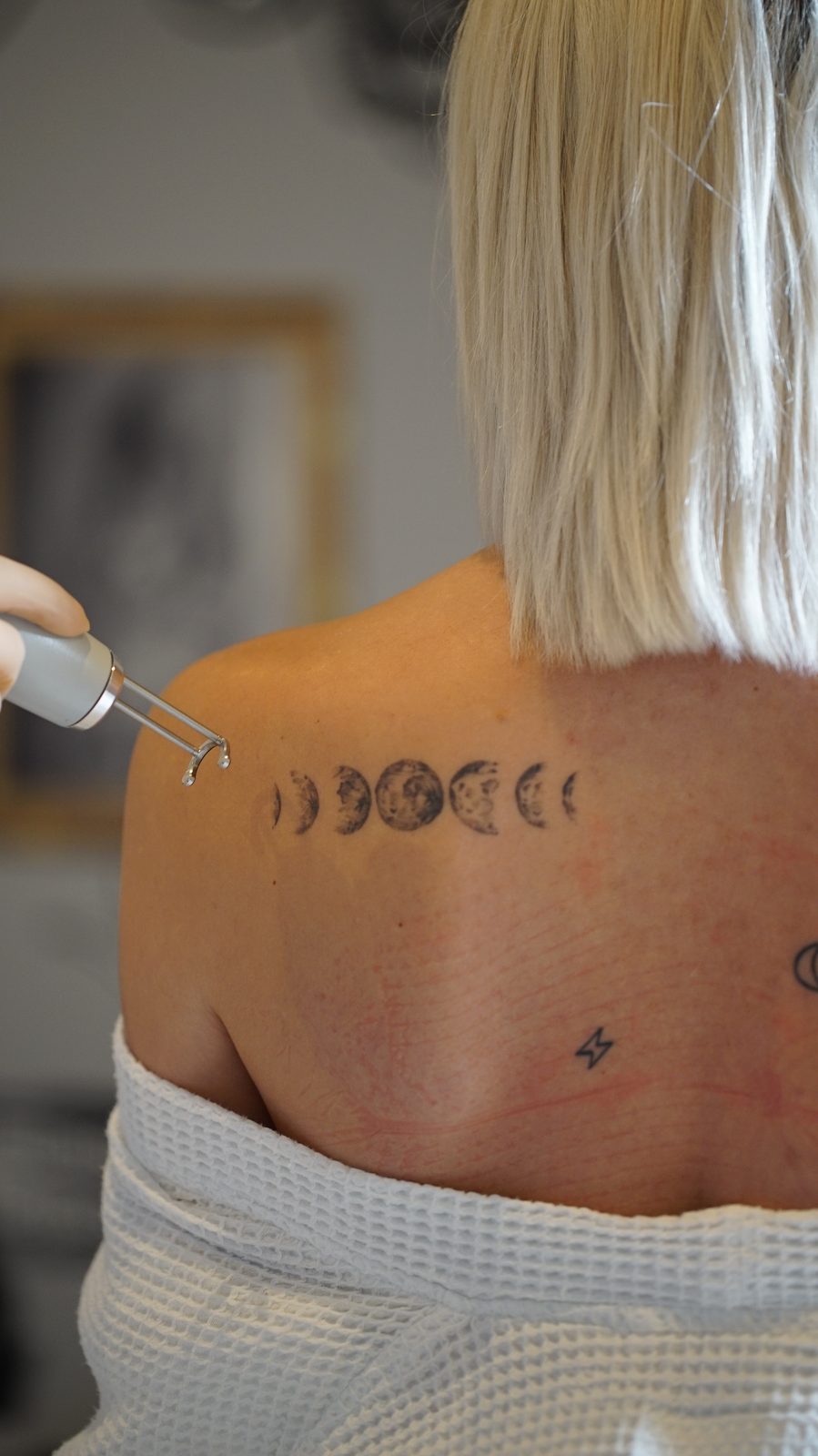 Détatouage laser en gros plan sur un tatouage d'épaule au laser picoseconde Pico Plus à Marseille