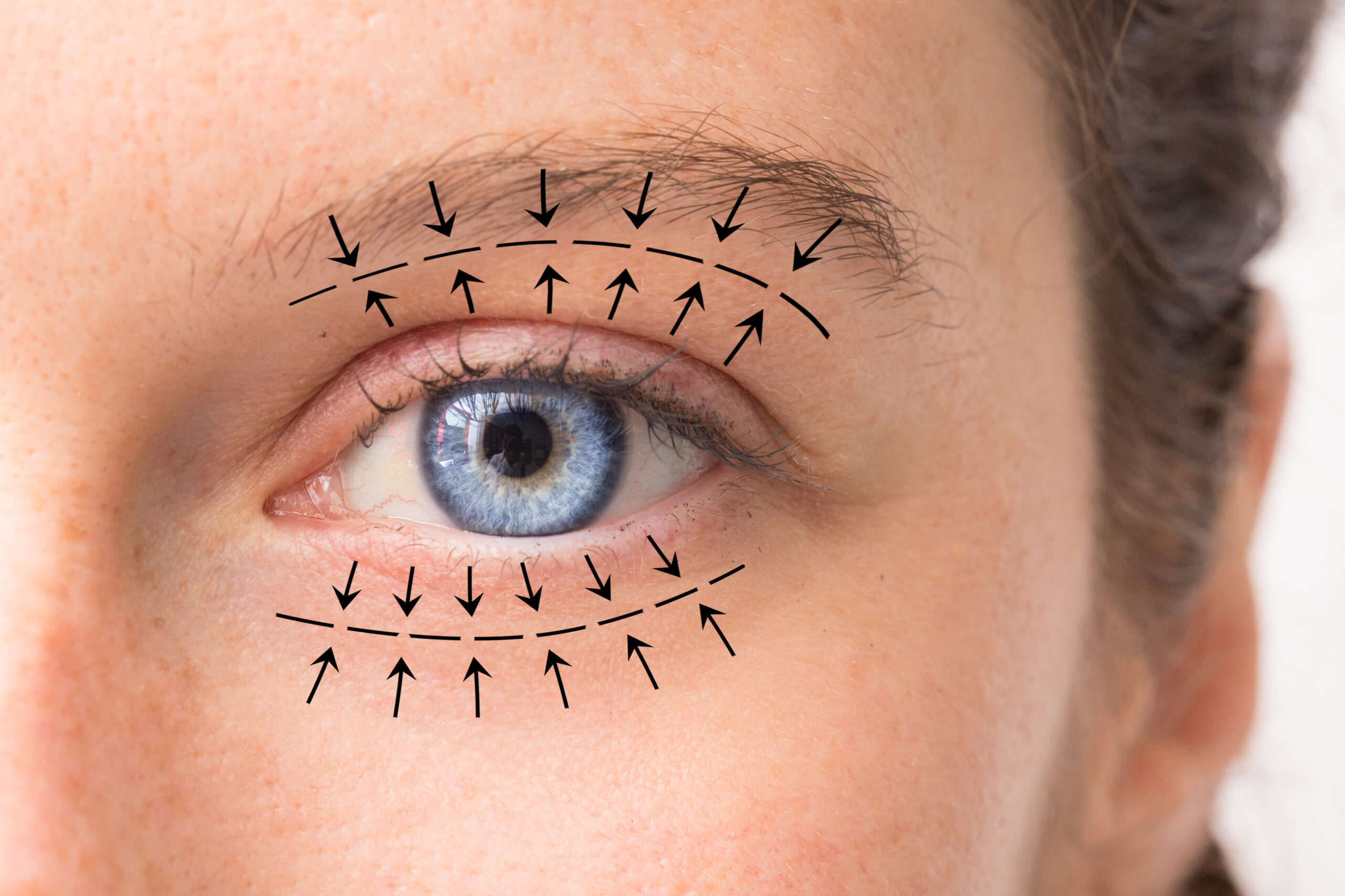 Blépharoplastie médicale au laser CO2 à Marseille — Clinique Phenicia