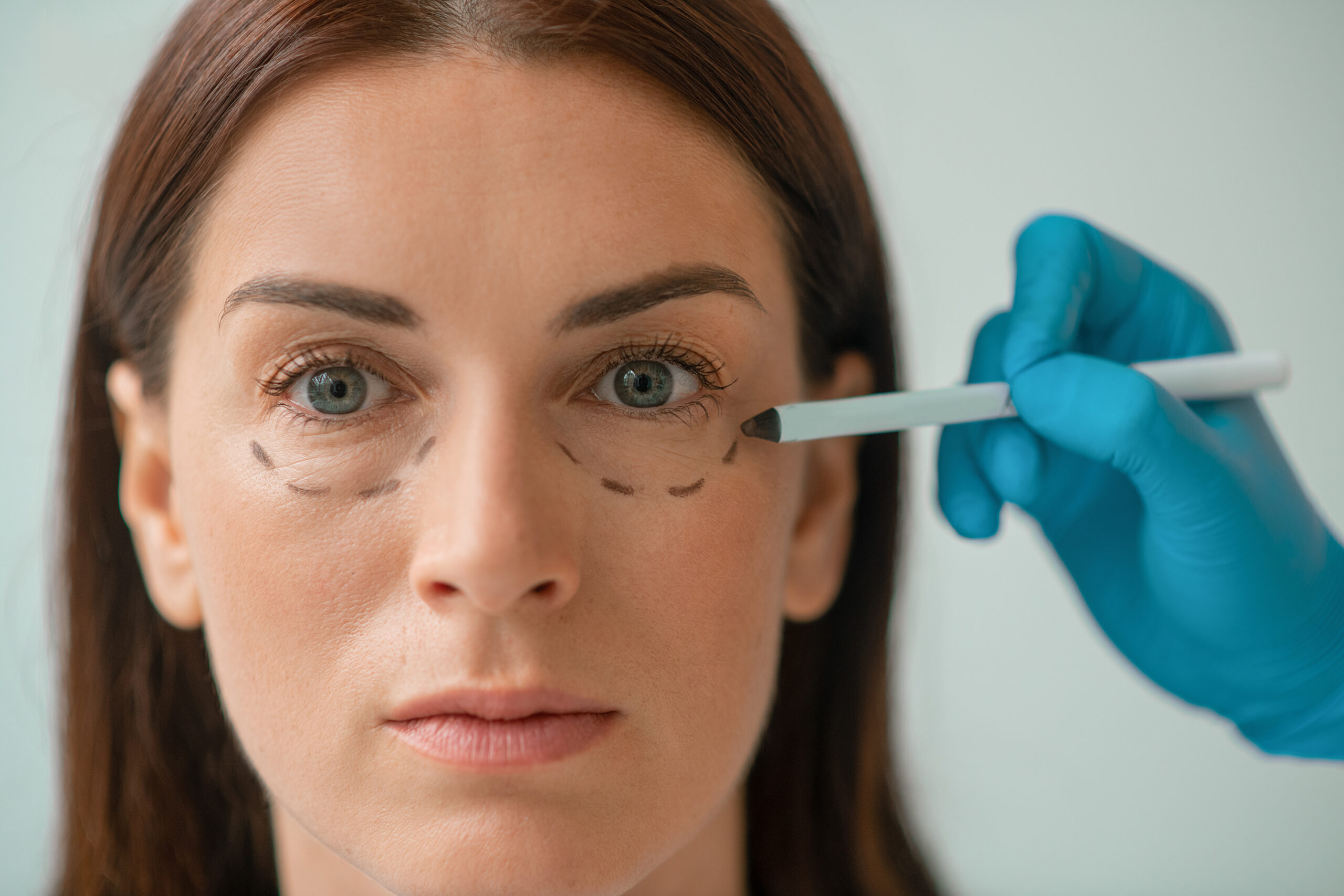 Consultation médicale avant blépharoplastie au laser CO2 — Clinique Phenicia Marseille