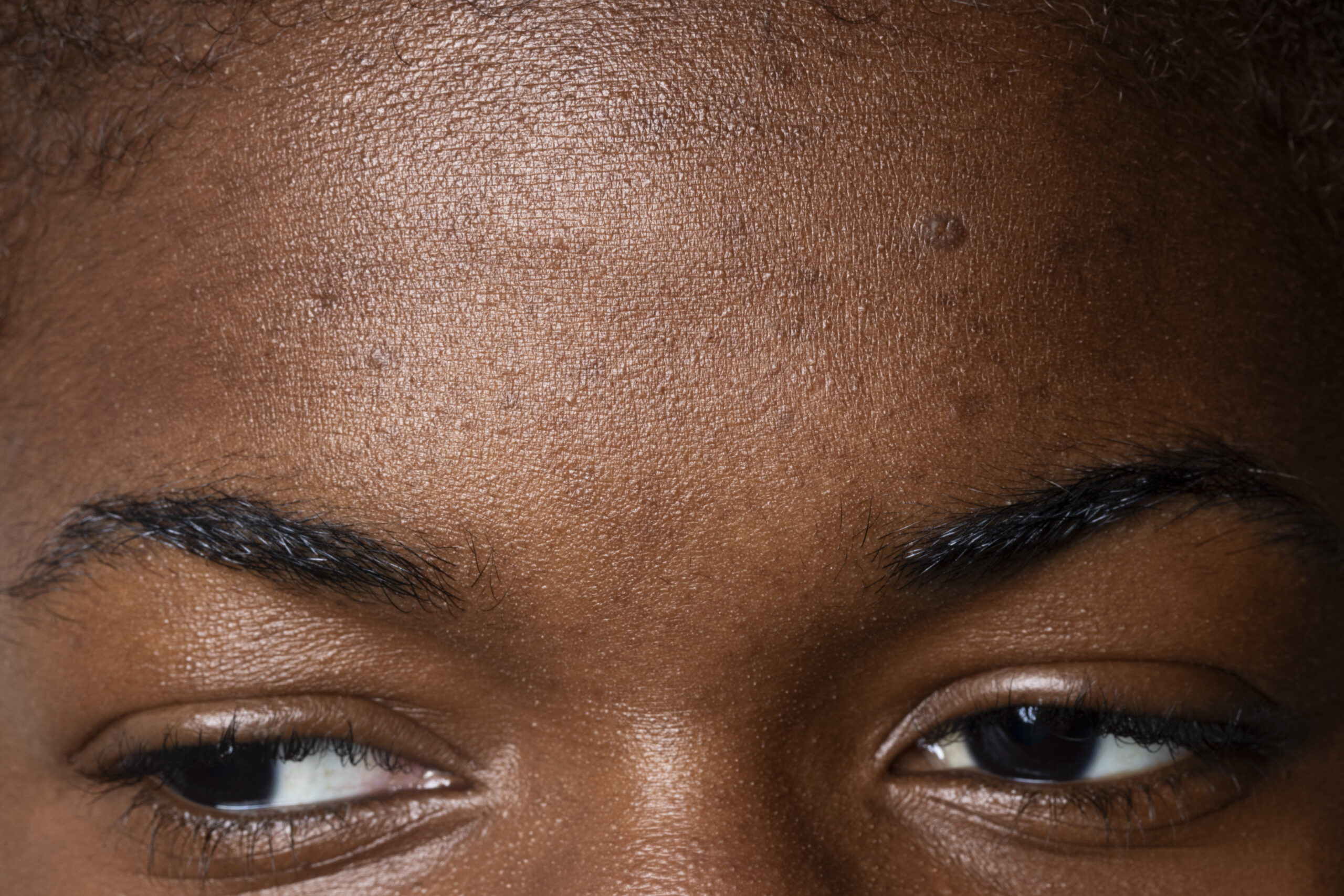 Traitement des taches pigmentaires du visage sur peau afro