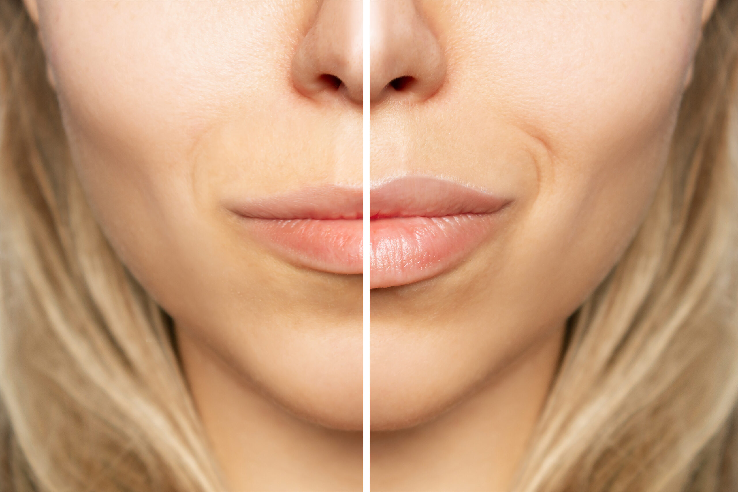Micro-injections de toxine botulique pour un Lip Flip