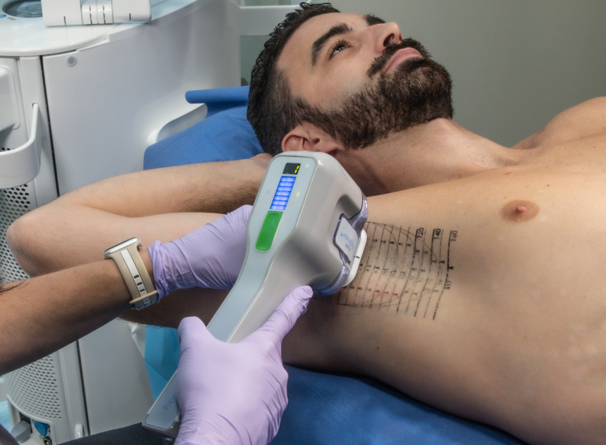 Effets transitoires et suites possibles après une séance de MiraDry