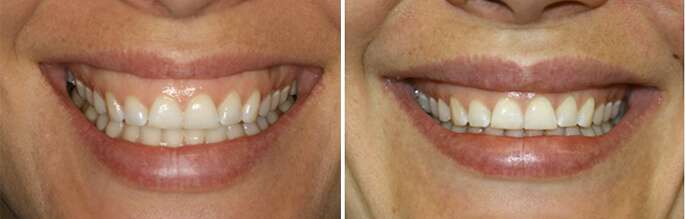 Sourire gingival avant et après traitement par toxine botulique à la Clinique Phenicia, Marseille